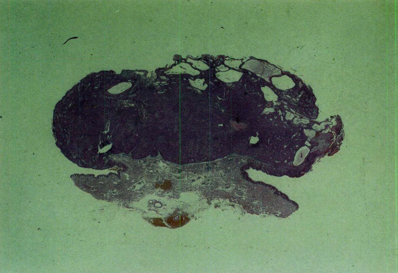 48. 汗 孔瘤